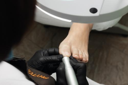 Ingrown toenail correction photo Ingrown toenail correction picture